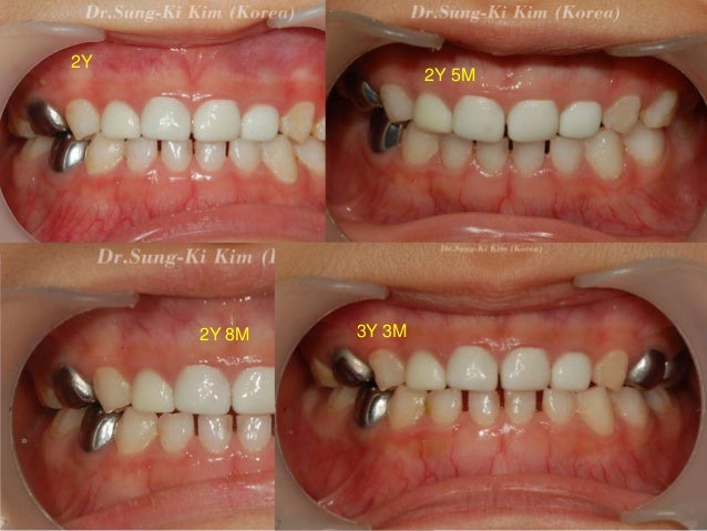 zirconia composition of crowns Zirconia teeth primary crowns and posterior anterior for zirconia composition of crowns Zirconia teeth primary crowns and posterior anterior for
