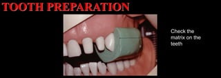 Dr. Paul A. Tipton
Check the
matrix on the
teeth
TOOTH PREPARATION
 