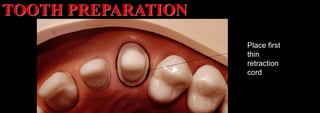 Dr. Paul A. Tipton
Place first
thin
retraction
cord
TOOTH PREPARATION
 