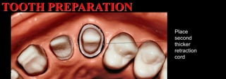 Dr. Paul A. Tipton
Place
second
thicker
retraction
cord
TOOTH PREPARATION
 