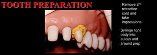 Dr. Paul A. Tipton
Remove 2nd
retraction
cord and
take
impressions
Syringe light
body into
sulcus and
around prep
TOOTH PREPARATION
 