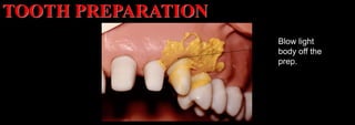 Dr. Paul A. Tipton
Blow light
body off the
prep.
TOOTH PREPARATION
 