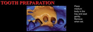 Dr. Paul A. Tipton
Place
medium
body in the
tray and seat
gently.
Remove
when set.
TOOTH PREPARATION
 