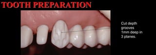 Dr. Paul A. Tipton
Cut depth
grooves
1mm deep in
3 planes.
TOOTH PREPARATION
 