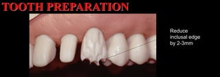 Dr. Paul A. Tipton
Reduce
inclusal edge
by 2-3mm
TOOTH PREPARATION
 