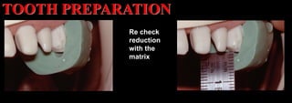 Dr. Paul A. Tipton
Re check
reduction
with the
matrix
TOOTH PREPARATION
 