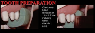 Dr. Paul A. Tipton
Check even
labial
reduction of
1.0 – 1.2 mm
including
labial
chamfer
prep
TOOTH PREPARATION
 