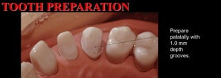 Dr. Paul A. Tipton
Prepare
palatally with
1.0 mm
depth
grooves.
TOOTH PREPARATION
 