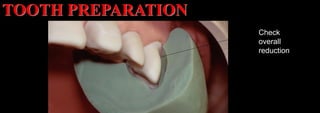 Dr. Paul A. Tipton
Check
overall
reduction
TOOTH PREPARATION
 