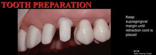 Dr. Paul A. Tipton Tipton training Limited
Keep
supragingival
margin until
retraction cord is
placed
TOOTH PREPARATION
 