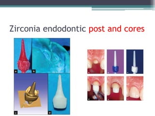 Zirconia endodontic post and cores
 