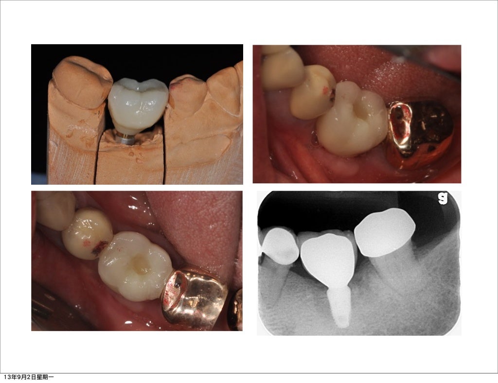 Zirconium for dental implant restoration