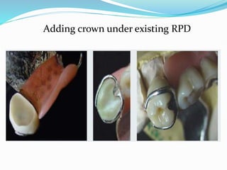 Rpd Add overview on zirkonzahn Abilities and limits | PPTX