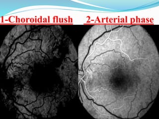 1-Choroidal flush 2-Arterial phase
 