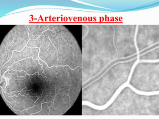 3-Arteriovenous phase
 