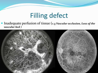 Filling defect
 Inadequate perfusion of tissue (e.g:Vascular occlusion, Loss of the
vascular bed )
 