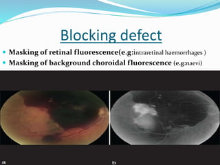 Blocking defect
 Masking of retinal fluorescence(e.g:intraretinal haemorrhages )
 Masking of background choroidal fluorescence (e.g:naevi)
 