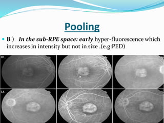 Pooling
 B ) In the sub-RPE space: early hyper-fluorescence which
increases in intensity but not in size .(e.g:PED)
 