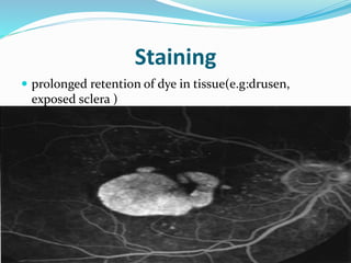 Staining
 prolonged retention of dye in tissue(e.g:drusen,
exposed sclera )
 