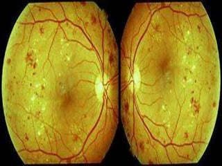 Eye Flourecein Angiography