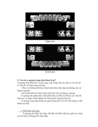 Upper jaw
Lower jaw
5. Vai trò x-quang trong nha khoa là gì?
X-quang Nha Khoa là vô giá trong việc cung cấp các nha sĩ với các hồ
sơ chi tiết về hàm răng của bạn.
- Nha sĩ sẽ không thể thực hành nha khoa hiện đại mà không cần sử
dụng x-quang.
- Kế hoạch điều trị được thực hiện bởi việc sử dụng x-quang.
- X-quang cho phép nha sĩ để phát hiện và điều trị bất kỳ các vấn đề
hiện tại, và ngăn chặn những tổn thương đó trong tương lai.
- X-quang cung cấp thông tin quan trọng đối với các tình trạng và thủ
thuật sau đây:
1. Phát hiện sâu răng
X-quang cho thấy sâu răng bắt đầu từ điểm tiếp xúc giữa các răng
nơi mà nha sĩ không thể nhìn thấy.
 