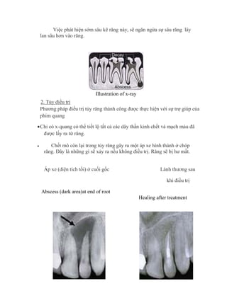 Việc phát hiện sớm sâu kẽ răng này, sẽ ngăn ngừa sự sâu răng lây
lan sâu hơn vào răng.
Illustration of x-ray
2. Tủy điều trị
Phương pháp điều trị tủy răng thành công được thực hiện với sự trợ giúp của
phim quang
Chỉ có x-quang có thể tiết lộ tất cả các dây thần kinh chết và mạch máu đã
được lấy ra từ răng.
 Chết mô còn lại trong tủy răng gây ra một áp xe hình thành ở chóp
răng. Đây là những gì sẽ xảy ra nếu không điều trị. Răng sẽ bị hư mất.
Áp xe (diện tích tối) ở cuối gốc Lành thương sau
khi điều trị
Abscess (dark area)at end of root
Healing after treatment
 