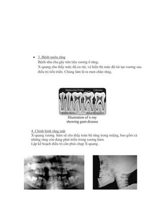  3. Bệnh nướu răng
Bệnh nha chu.gây nên tiêu xương ổ răng,
X-quang cho thấy mức độ co rút, và hiển thị mức độ tái tạo xương sau
điều trị tiến triển. Chúng làm lộ ra men chân răng,
Illustration of x-ray
showing gum disease
4. Chỉnh hình răng mặt
X-quang xương hàm sẽ cho thấy toàn bộ răng trong miệng, bao gồm cả
những răng còn đang phát triển trong xương hàm.
Lập kế hoạch điều trị cần phải chụp X-quang .
 