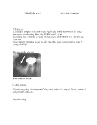 Orthodontic x-ray Lower jaw protrusion
5. Răng giả
X-quang có thể phát hiện tàn tích của nguồn gốc có thể đã được còn lại trong
xương sau khi nhổ răng. Điều này đôi khi có thể xảy ra.
Chân răng này có thể tồn tại trong nhiều năm, và chỉ trở thành một vấn đề ở giai
đoạn sau.
Trước điều trị hàm răng giả có thể cần phải phẫu thuật răng miệng khi chụp X-
quang phát hiện.
Gốc còn sót lại trên trái
Root remnant on left
6. Chấn thương
Chấn thương răng và xương có thể được nhìn thấy trên x-ray, và điều trị sau đó có
thể được lên kế hoạch.
Gãy chân răng
 