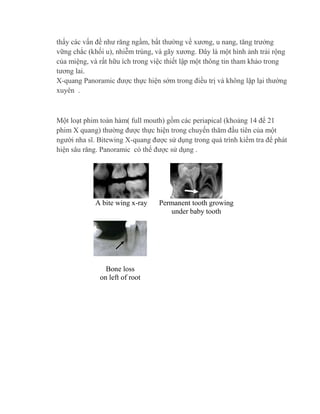 thấy các vấn đề như răng ngầm, bất thường về xương, u nang, tăng trưởng
vững chắc (khối u), nhiễm trùng, và gãy xương. Đây là một hình ảnh trải rộng
của miệng, và rất hữu ích trong việc thiết lập một thông tin tham khảo trong
tương lai.
X-quang Panoramic được thực hiện sớm trong điều trị và không lặp lại thường
xuyên .
Một loạt phim toàn hàm( full mouth) gồm các periapical (khoảng 14 để 21
phim X quang) thường được thực hiện trong chuyến thăm đầu tiên của một
người nha sĩ. Bitewing X-quang được sử dụng trong quá trình kiểm tra để phát
hiện sâu răng. Panoramic có thể được sử dụng .
A bite wing x-ray Permanent tooth growing
under baby tooth
Bone loss
on left of root
 