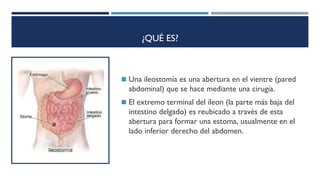 ¿QUÉ ES?
◼ Una ileostomía es una abertura en el vientre (pared
abdominal) que se hace mediante una cirugía.
◼ El extremo terminal del íleon (la parte más baja del
intestino delgado) es reubicado a través de esta
abertura para formar una estoma, usualmente en el
lado inferior derecho del abdomen.
 