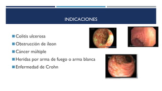 INDICACIONES
◼Colitis ulcerosa
◼Obstrucción de íleon
◼Cáncer múltiple
◼Heridas por arma de fuego o arma blanca
◼Enfermedad de Crohn
 