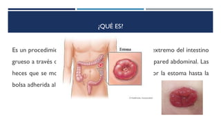 ¿QUÉ ES?
Es un procedimiento quirúrgico en el que se saca un extremo del intestino
grueso a través de una abertura (estoma) hecha en la pared abdominal. Las
heces que se movilizan a través del intestino salen por la estoma hasta la
bolsa adherida al abdomen.
 