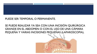 PUEDE SER TEMPORAL O PERMANENTE.
SE PUEDE REALIZAR YA SEA CON UNA INCISIÓN QUIRÚRGICA
GRANDE EN EL ABDOMEN O CON EL USO DE UNA CÁMARA
PEQUEÑA Y VARIAS INCISIONES PEQUEÑAS (LAPAROSCOPIA).
 