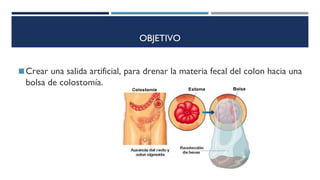 OBJETIVO
◼Crear una salida artificial, para drenar la materia fecal del colon hacia una
bolsa de colostomía.
 