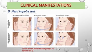 D. Head impulse test
CLINICAL MANIFESTATIONS
[ Scott brown otorhinolaryngology, 7th
edition,vol 3]
 