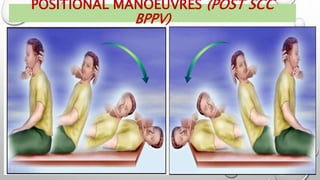 POSITIONAL MANOEUVRES (POST SCC
BPPV)
 