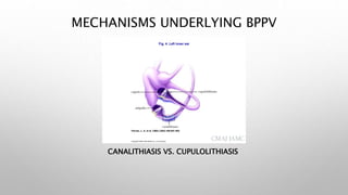 MECHANISMS UNDERLYING BPPV
Copyright ©2003 CMA Media Inc. or its licensors
Parnes, L. S. et al. CMAJ 2003;169:681-693
Fig. 4: Left inner ear
CANALITHIASIS VS. CUPULOLITHIASIS
 
