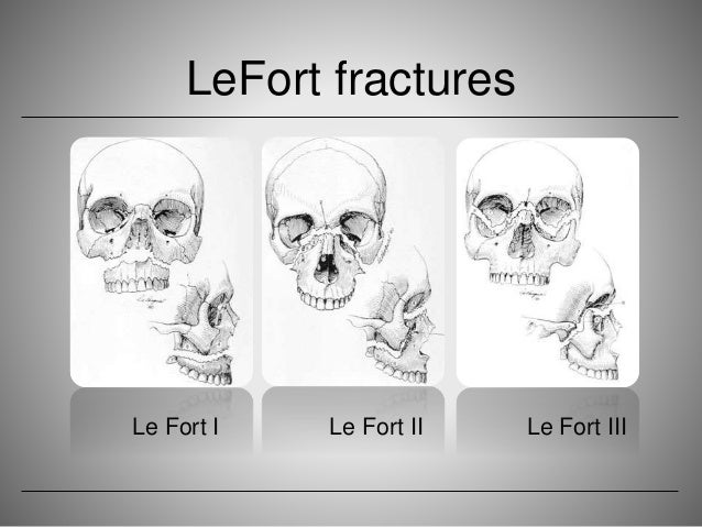 Midfacial fracture