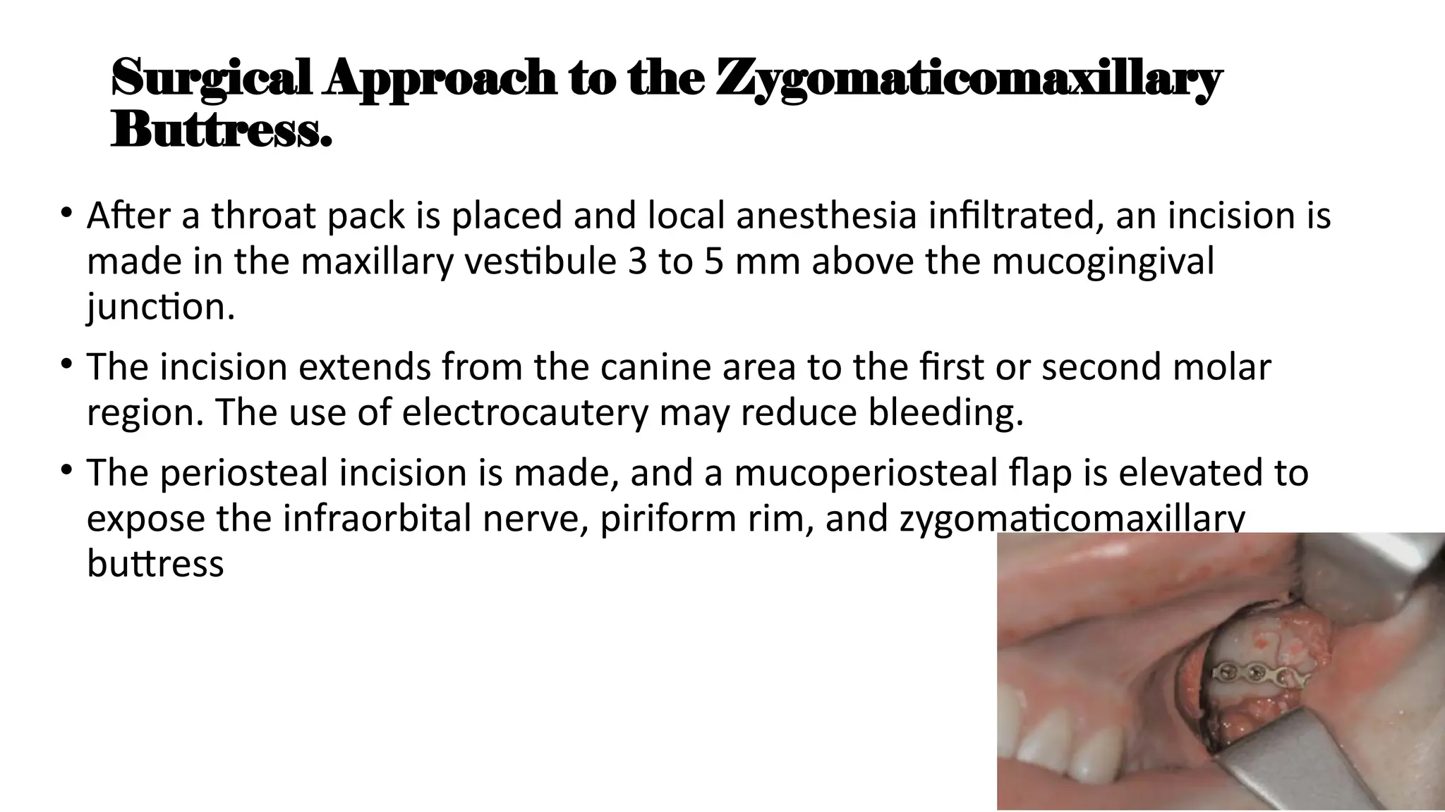 Surgical Approach to the Zygomaticomaxillary
Buttress.
• After a throat pack is placed and local anesthesia infiltrated, an incision is
made in the maxillary vestibule 3 to 5 mm above the mucogingival
junction.
• The incision extends from the canine area to the first or second molar
region. The use of electrocautery may reduce bleeding.
• The periosteal incision is made, and a mucoperiosteal flap is elevated to
expose the infraorbital nerve, piriform rim, and zygomaticomaxillary
buttress
 