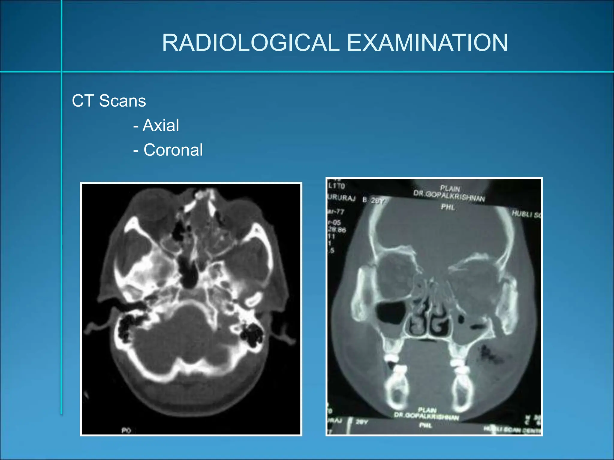 ZMC Fractures - Copy.ppt zygomatico maxillary fracture | PPT
