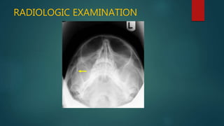 Zmc fractures part 1 | PPTX