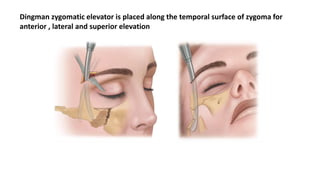 Zincral Riser Zmc fractures and management | PPTX