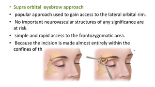 Zmc fractures and management | PPTX