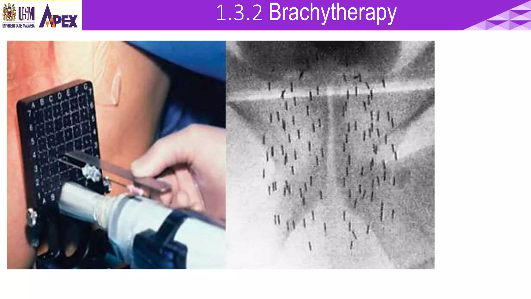 introduction of Radiotherapy | PPTX