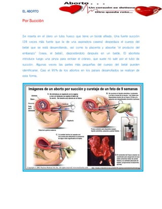 Por Succión
Se inserta en el útero un tubo hueco que tiene un borde afilado. Una fuerte succión
(28 veces más fuerte que la de una aspiradora casera) despedaza el cuerpo del
bebé que se está desarrollando, así como la placenta y absorbe "el producto del
embarazo" (osea, el bebé), depositándolo después en un balde. El abortista
introduce luego una pinza para extraer el cráneo, que suele no salir por el tubo de
succión. Algunas veces las partes más pequeñas del cuerpo del bebé pueden
identificarse. Casi el 95% de los abortos en los países desarrollados se realizan de
esta forma.
 