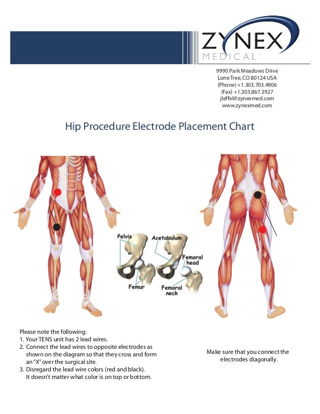 Tens Electrode Placement Chart
