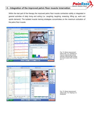 4 – Integration of the improved pelvic floor muscle innervation
Within the last part of the therapy the improved pelvic floor muscle contraction ability is integrated in
general activities of daily living and acting (i.e. caughing, laughing, sneezing, lifting up, work and
sports demand). The isolated muscle training strategies concentrates on the maximum activation of
the pelvic floor muscle.

Fig. 14: (Same measurement
setup as fig. 13). Treadmill running as a typical daily activity
exercise. Note the high contraction level of pelvic floor muscles
(ch. 1)

Fig. 15: (Same measurement
setup as fig. 13). Hopping on a
trampoline.

 
