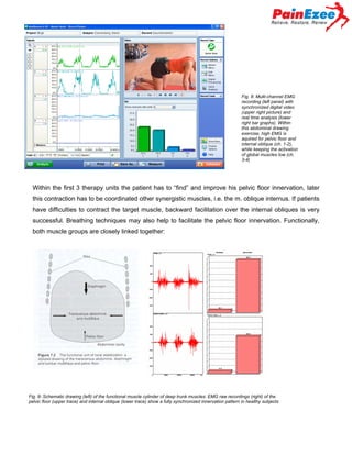 Fig. 8: Multi-channel EMG
recording (left panel) with
synchronized digital video
(upper right picture) and
real time analysis (lower
right bar graphs). Within
this abdominal drawing
exercise, high EMG is
aquired for pelvic floor and
internal oblique (ch. 1-2),
while keeping the activation
of global muscles low (ch.
3-4)

Within the first 3 therapy units the patient has to “find” and improve his pelvic floor innervation, later
this contraction has to be coordinated other synergistic muscles, i.e. the m. oblique internus. If patients
have difficulties to contract the target muscle, backward facilitation over the internal obliques is very
successful. Breathing techniques may also help to facilitate the pelvic floor innervation. Functionally,
both muscle groups are closely linked together:

Aus: Richardson et al
1999, page 95

Synergy of pelvic floor lower deep
Abdominal muscles (healthy subject)

Fig. 9: Schematic drawing (left) of the functional muscle cylinder of deep trunk muscles: EMG raw recordings (right) of the
pelvic floor (upper trace) and internal oblique (lower trace) show a fully synchronized innervation pattern in healthy subjects

 