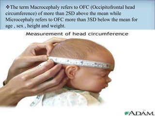 The term Macrocephaly refers to OFC (Occipitofrontal head
circumference) of more than 2SD above the mean while
Microcephaly refers to OFC more than 3SD below the mean for
age , sex , height and weight.
27
 