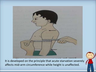 30
It is developed on the principle that acute starvation severely
affects mid-arm circumference while height is unaffected.
 